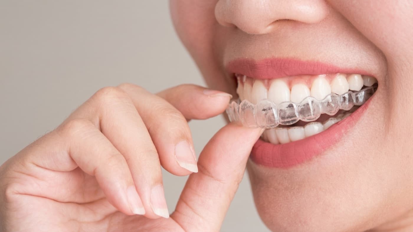 Şeffaf Plak (Invisalign) Fiyatlarını Belirleyen Faktörler